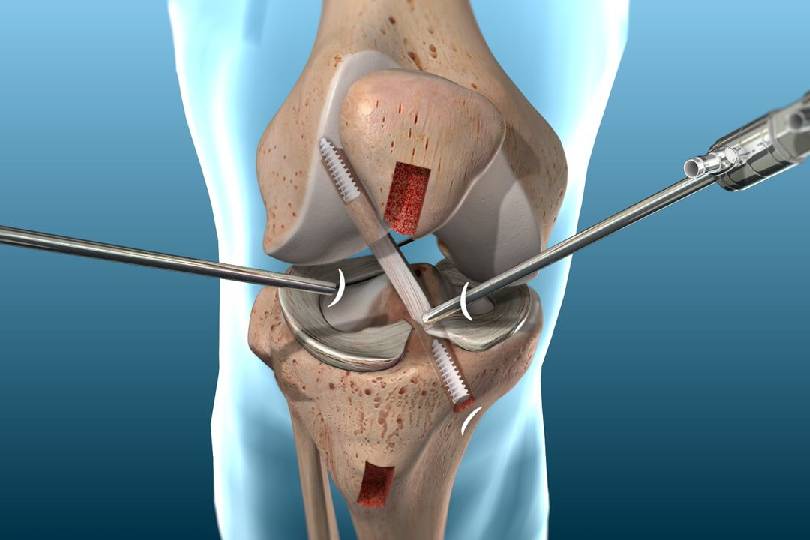 Ligament Reconstruction
