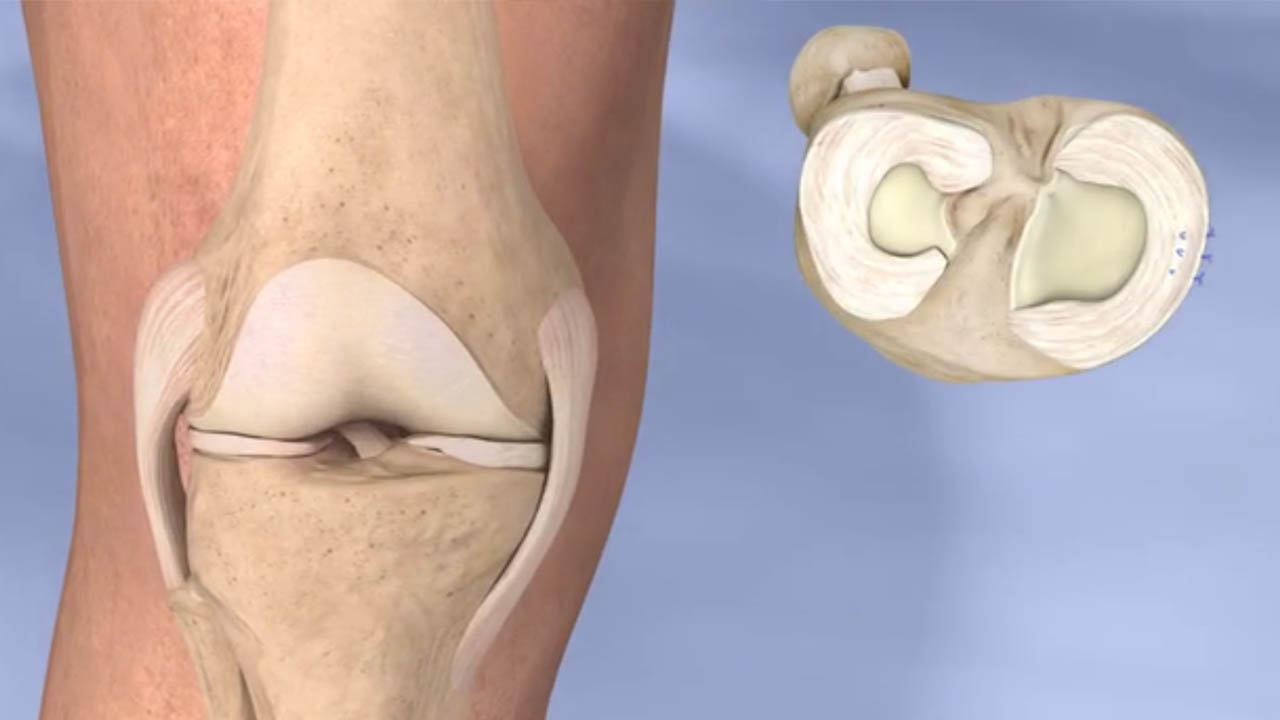 Meniscus Repair