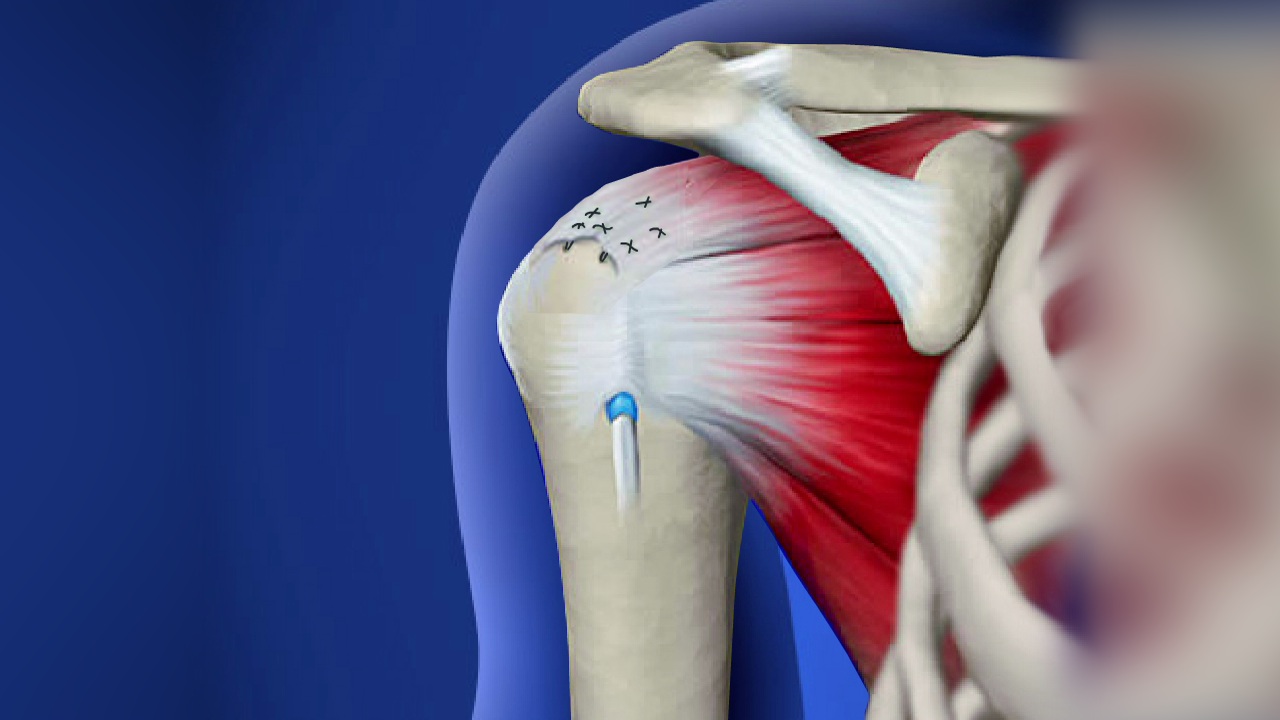 Rotator Cuff